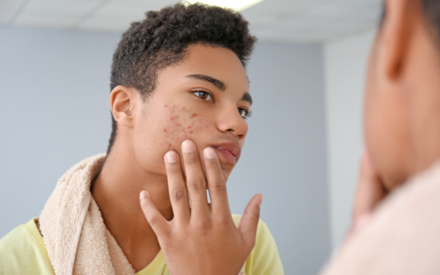 natuurlijke behandeling tegen acne met zink nutri-bel